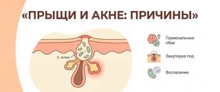 Прыщи и акне: причины, гормоны и какие анализы сдавать