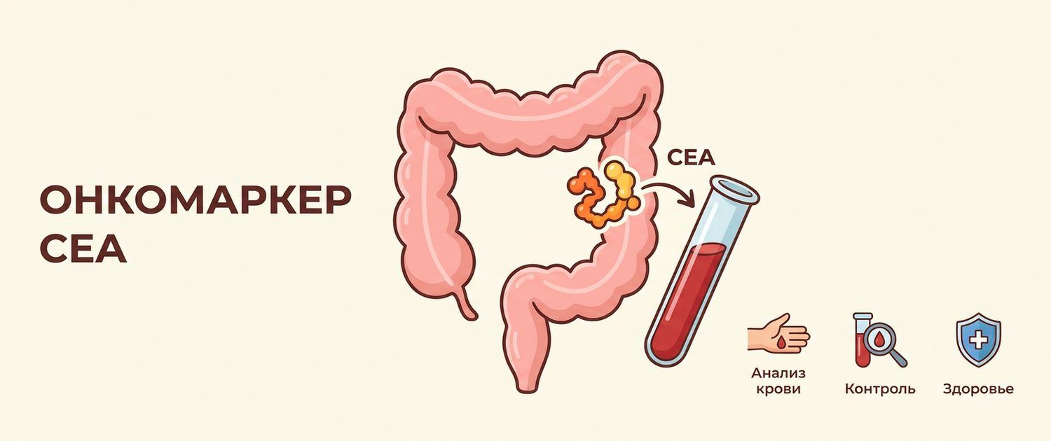 Онкомаркер CEA (РЭА): нормы, расшифровка и причины повышения