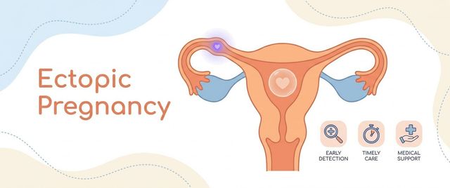 Ectopic Pregnancy: Signs, Symptoms and the Role of hCG